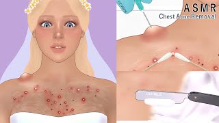 Satisfying! chest acne blackhead removal | animation | pimples skin care | bridal spa