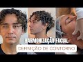 Harmonização Facial Surpreendente: Antes e Depois - Transformação com Ácido Hialurônico e Reação.