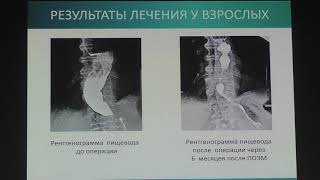 04 Федотов ЛЕ Ахалазия пищевода Пероральная эндоскопическая миотомия