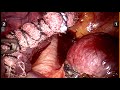 robotic mediastinal tumour excision schwanomma