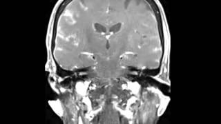 Leptomeningeal Carcinomatosis