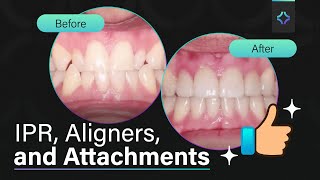 Bolton Blunders? Not Anymore! Achieving Clear Aligner Success ✨ Ep.10