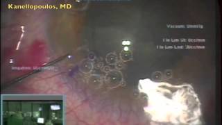 Bladeless cataract surgery with femtosecond and nanosecond lasers [ID 47188]