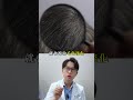 一夜白髮是真的嗎？ myhair生髮植鬍診所 陳煜勛醫師 科普 推薦 髮際線 高雄植髮 hair