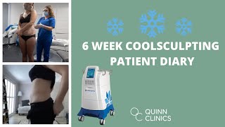 COOLSCULPTING - WHAT TO EXPECT | FREEZE FAT OFF! Does CoolSculpting Work? | Quinn Clinics