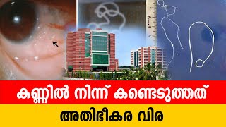 കണ്ണിൽ നിന്ന് കണ്ടെടുത്തത് അതിഭീകര വിര... #eenadumalayalam #latestnews