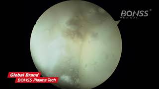 BONSS RF PLASMA Shoulder Arthroscopy