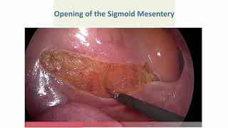 Asvide: Opening the sigmoid mesentery