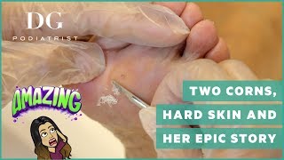 Two repeating corns for 30 years, hard skin and her epic story