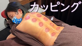 【カッピング むくみ】カッピングで院長の背中に乗ったむくみを一掃します！ お得情報もあります♪【世田谷 奥沢 鍼灸治療院サロンQ】