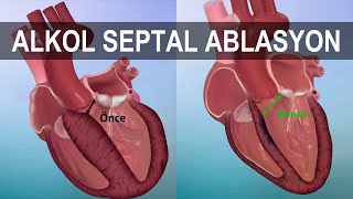 ALKOL SEPTAL ABLASYON NEDİR?