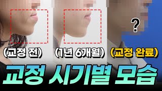 주걱턱 교정 도대체 언제부터 예뻐질까요?