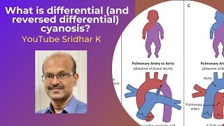 What is differential cyanosis? When do we see it? Reversed differential cyanosis? Dr Sridhar K