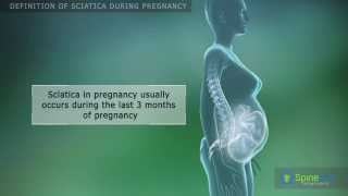 Sciatica During Pregnancy Definition