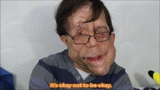 Living with Neurofibromatosis (Adam Pearson)