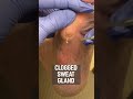 Doctor removes clogged sweat gland on foot! 😳🤯 #shorts #callus