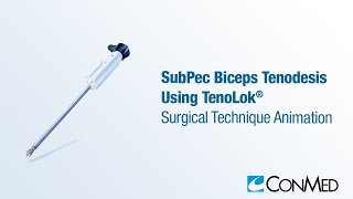 SubPec Biceps Tenodesis Using TenoLok® - CONMED Animation