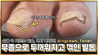 두꺼워진 발톱, 내 살을 콕! 찌르고 있다... / Ouch! An ingrown toenail is poking into my flesh / 내성발톱