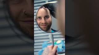 4000 GRAFTS HAIR TRANSPLANT 9 MONTHS RESULT!