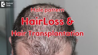 Hair transplantation in androgenic alopecia - Dr. Shashi Kiran A R