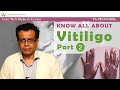 What is Vitiligo and Causes Of  Leucoderma  | Dr.Sandeep Bhasin