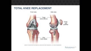 RebalanceMD Total Knee Replacement