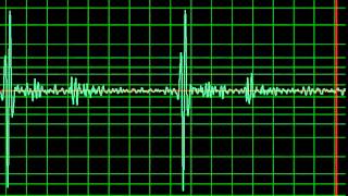 Aortic Regurgitation, Ejection Systolic Murmur- normal speed