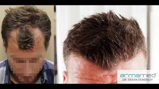 Dr.Erkan Demirsoy 2843 Grafts Fue Before After Photos