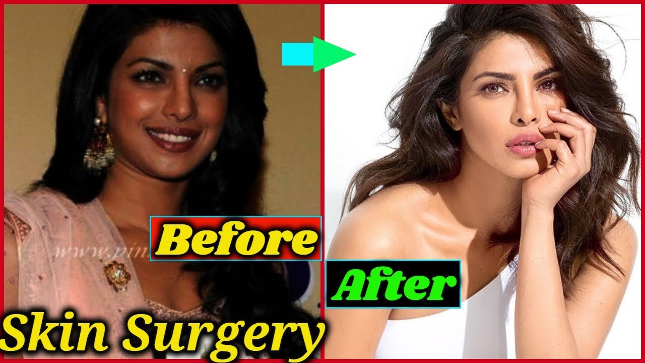 Bollywood Actresses Who Went For Skin Lightening Treatment - YouTube