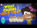 What Causes Head Lice? | Treatment For Head Lice | The Dr Binocs Show | Peekaboo Kidz