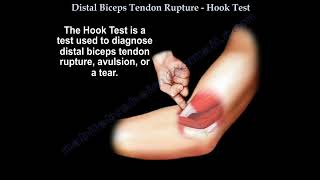 Distal biceps tendon tear,