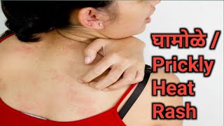 त्वचा रोग भाग १३ घामोळे घरगुती उपाय | | Ghamole Upay | prickly heat rash remedy | @aaichabatva629