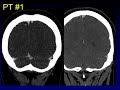 Mimics:  Dural Venous Sinus