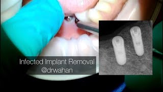 Infected Dental Implant Removal with Trephines: Explant