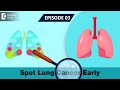 EARLY WARNING SIGNS of Lung Cancer | Spot Lung Cancer Early | Lung Cancer Screening- Doctors' Circle