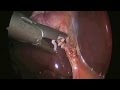 Single Incision Laparoscopic Cholecystectomy