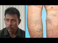 શું છે varicose veins તેનો ઈલાજ શું છે શું તેનો કોઈ સરળ ઈલાજ છે