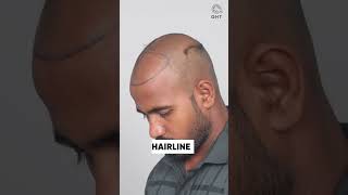 Nine Months Hair Transplant Results | Latest Fue Technique #shorts #viral #hair transplant