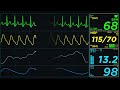 ekg monitor normal