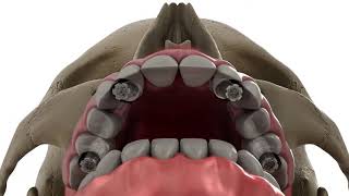 Complete Guide of All on 4 Implants Vadodara, India