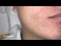 무한대로 나오는 피지 연가시 여드름 고름 ニキビ blackhead