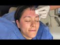 Demonstration of Botox, Morpheus 8 (RF-Microneedling)with PRP (Vampire Facial)