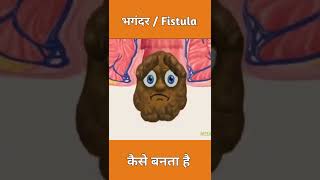 fistula symptoms | fistula symptoms in hindi | fistula in hindi #shortvideo #viral #viralvideo