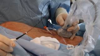 Endovenous Thermal Ablation // Varicose Vein Removal