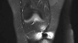 ACL Arthrofibrosis