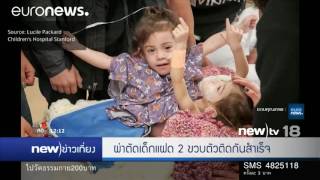 ผ่าตัดเด็กแฝด 2 ขวบตัวติดกันสำเร็จ | 12-12-59 | new)ข่าวเที่ยง | new)tv