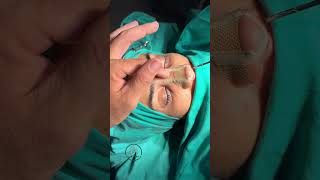 Rhinoplasty öncesi-sonrası