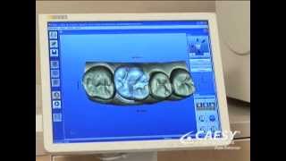 Crown Restoration with Cerec at North Shore Dentist