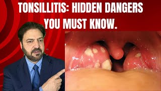 How to Know if Your Tonsillitis Needs Surgery or Not | DOCTORJ