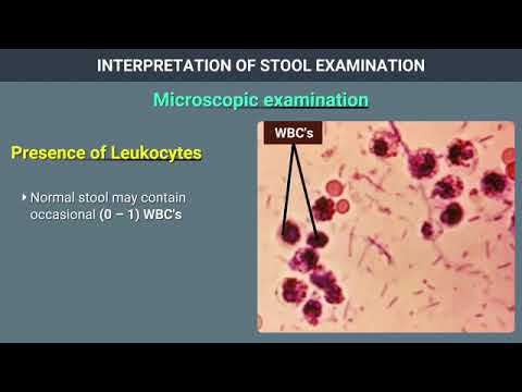 Interpretation Of Stool Examination - YouTube